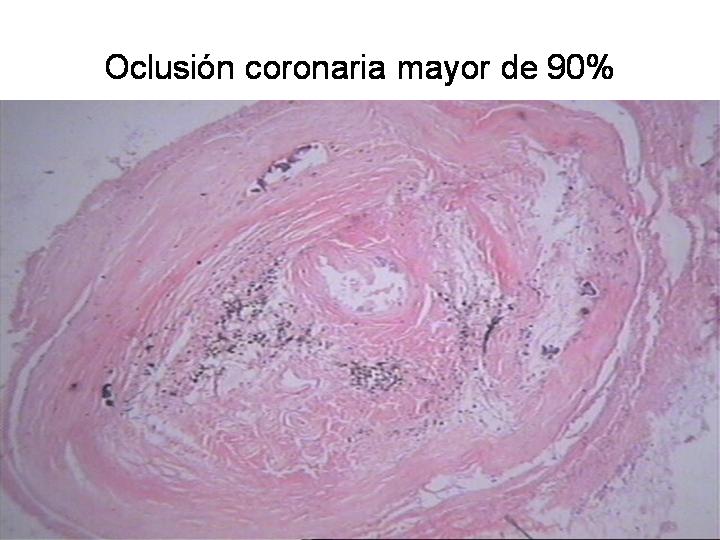 ASPECTO MICROSCOPICO. OCLUSION CORONARIA - <div style=